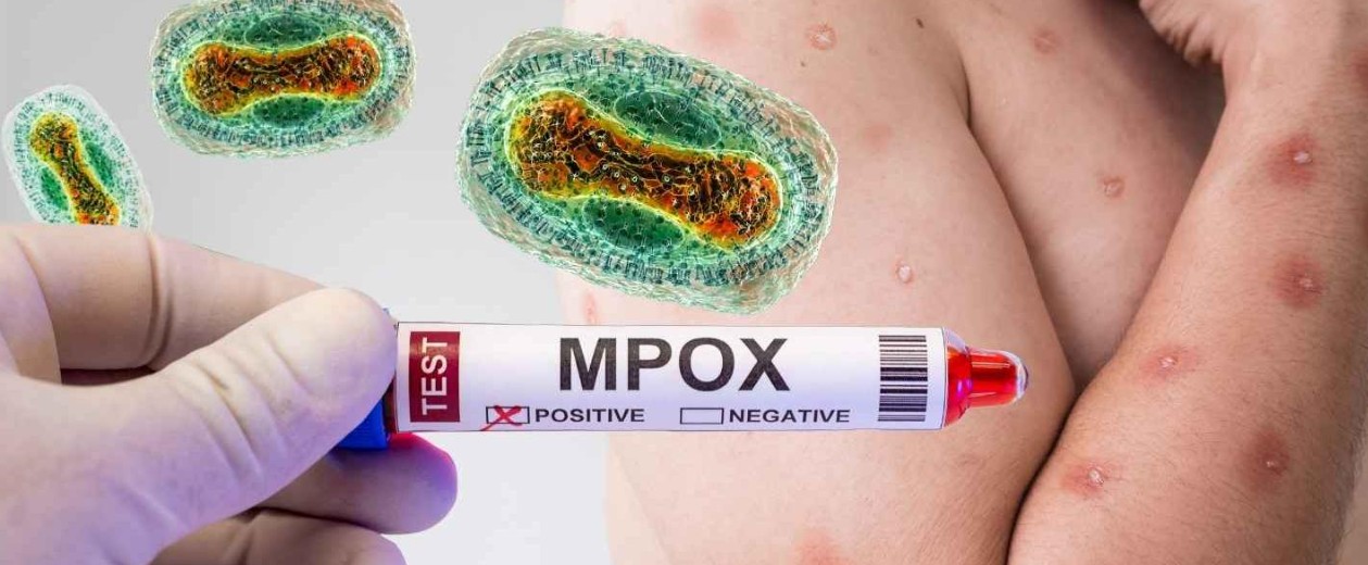 1.268 muertes por mpox y más de 69.000 casos en África durante 2024
